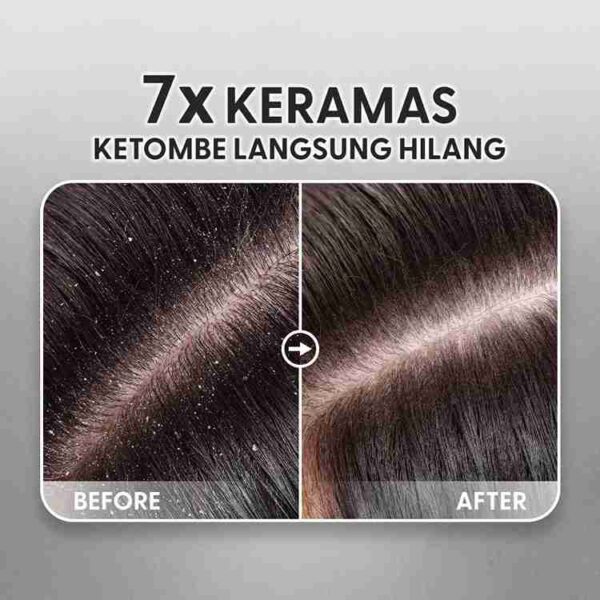 O'sweet Singapore Anti Ketombe - Before After 7x Keramas