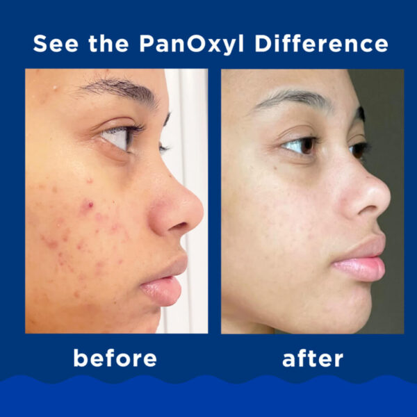 Panoxyl - Before After