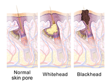 ilustrasi kulit normal, whitehead, blackhead