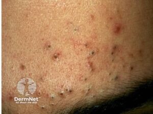 komedo terbuka, komedo hitam, blackhead